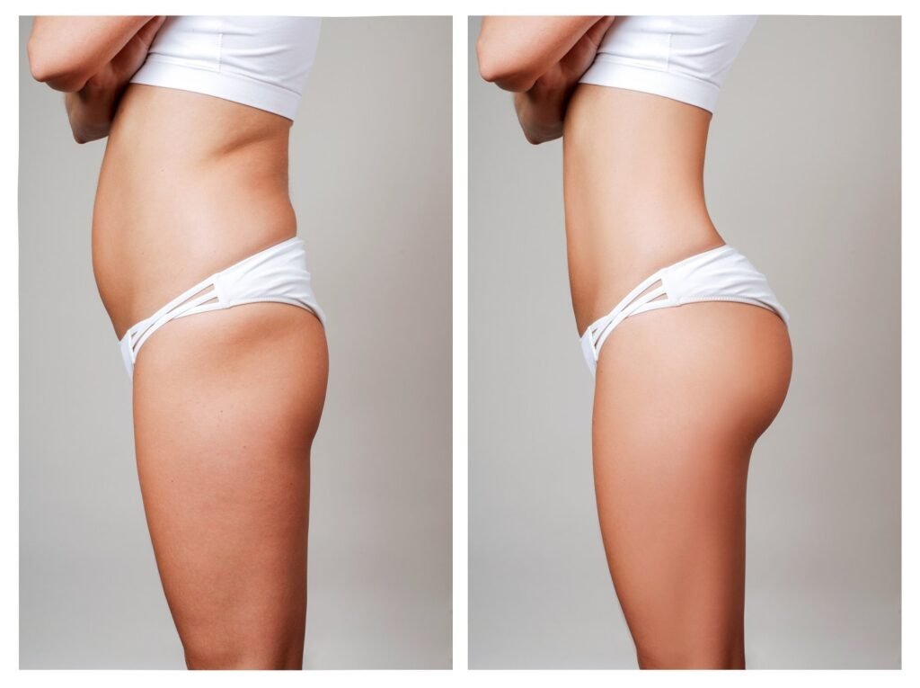 Butt-Lift-Gluteoplasty22