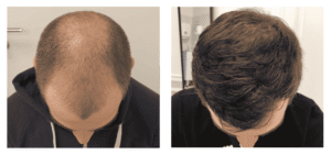 Hair-transplantation-before-and-after-2-1