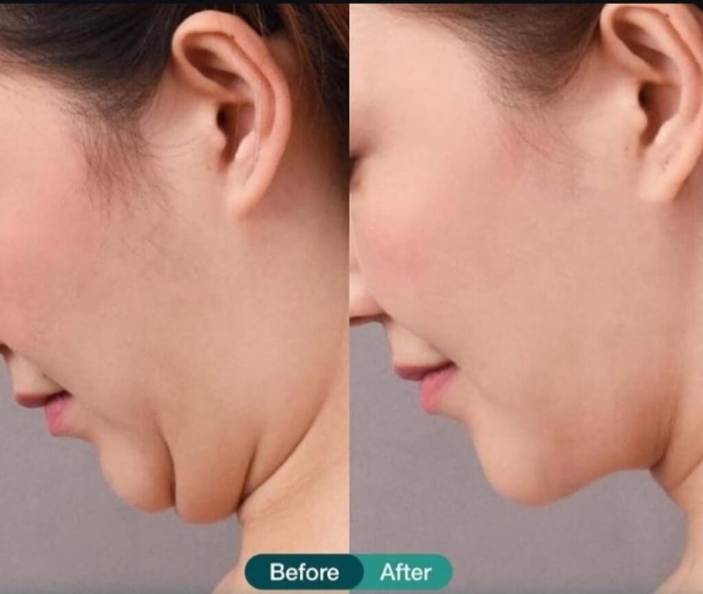 تجميل الذقن
