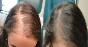 افضل-اماكن-زراعة-الشعر-في-مصر-2